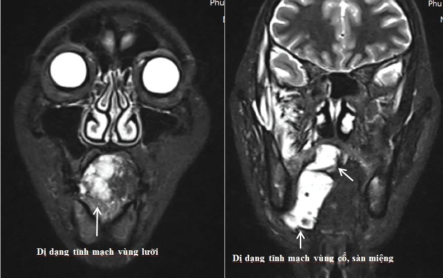 Hình ảnh chụp cộng hưởng từ bệnh nhân bị dị dạng tĩnh mạch phức tạp vùng lưỡi và vùng cổ, mặt và sàn miệng