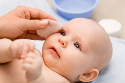 Cần vệ sinh mắt cho bé theo hướng dẫn bác sỹ hàng ngày trong thời gian điều trị tắc lệ đạo