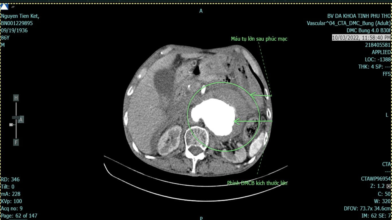 Hình ảnh chụp cắt lớp vi tính của người bệnh vỡ phình động mạch chủ bụng trước phẫu thuật 