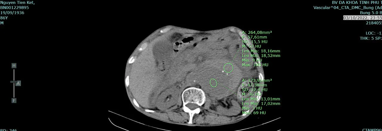 Hình ảnh chụp cắt lớp vi tính của người bệnh vỡ phình động mạch chủ bụng trước phẫu thuật