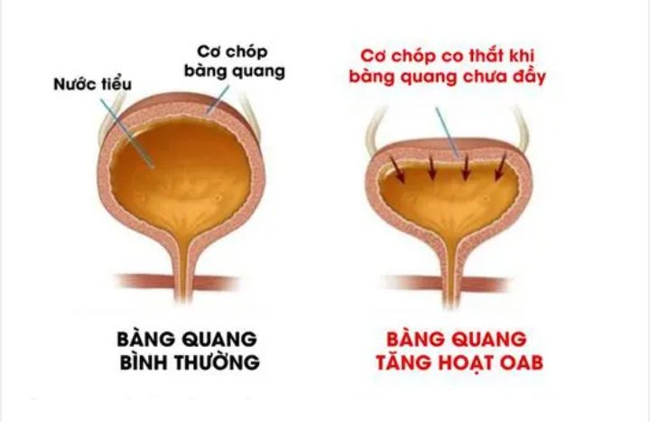 Bàng quang tăng hoạt