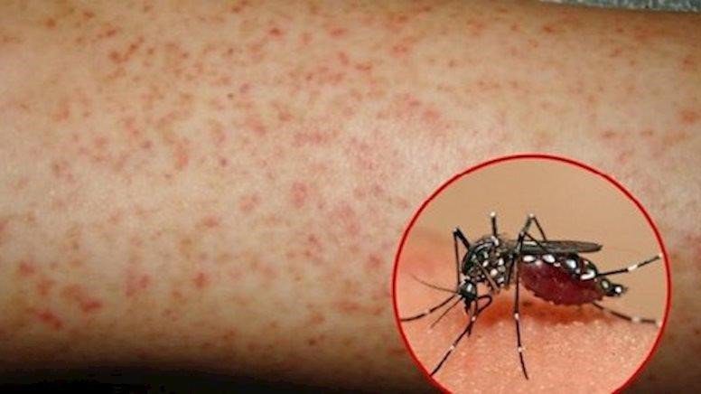 Người bị nhiễm virus Dengue do muỗi mang virus Dengue đốt