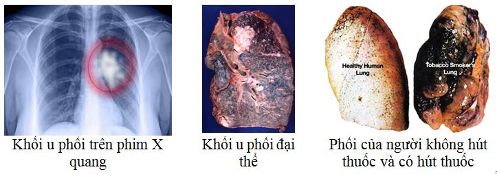 Ung thư phổi