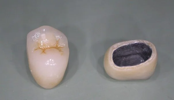 Hình ảnh mô phỏng Răng sứ kim loại Crom-Niken