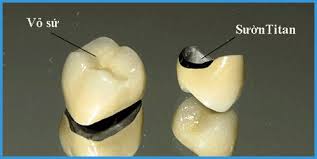 Hình ảnh mô phỏng Răng sứ kim loại Titan