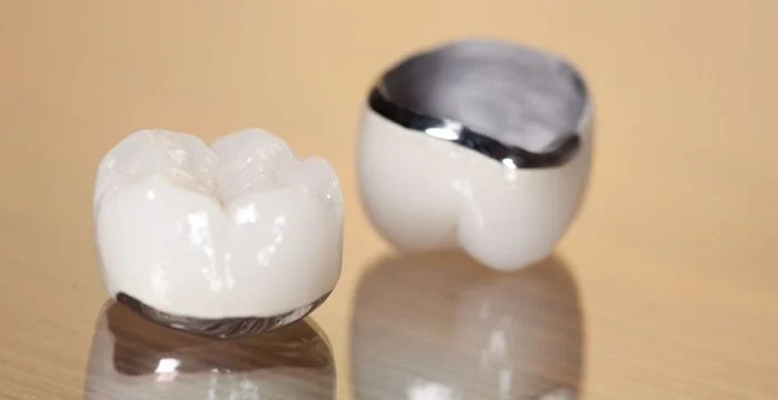 Hình ảnh mô phỏng Răng sứ kim loại Crom-Coban