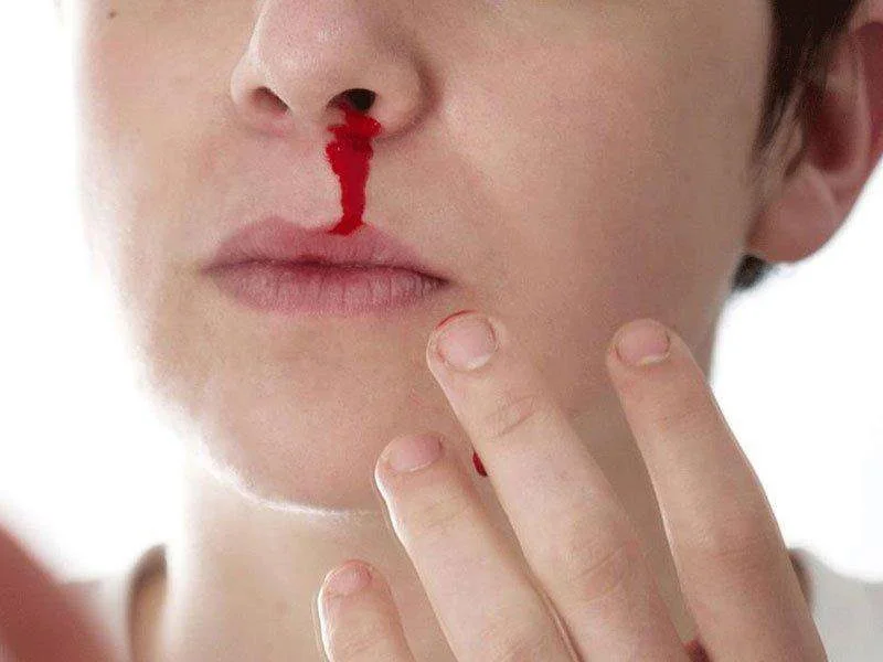Biến chứng chảy máu mũi khi mắc SXHD.Sốc