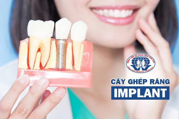 Cấy ghép Implant là giải pháp tối ưu cho người bị mất răng