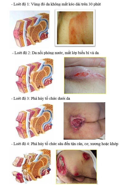 Loét ép – Thương tật thứ cấp thường mắc phải ở người bệnh sau Đột quỵ não 1 Các giai đoạn của loét ép