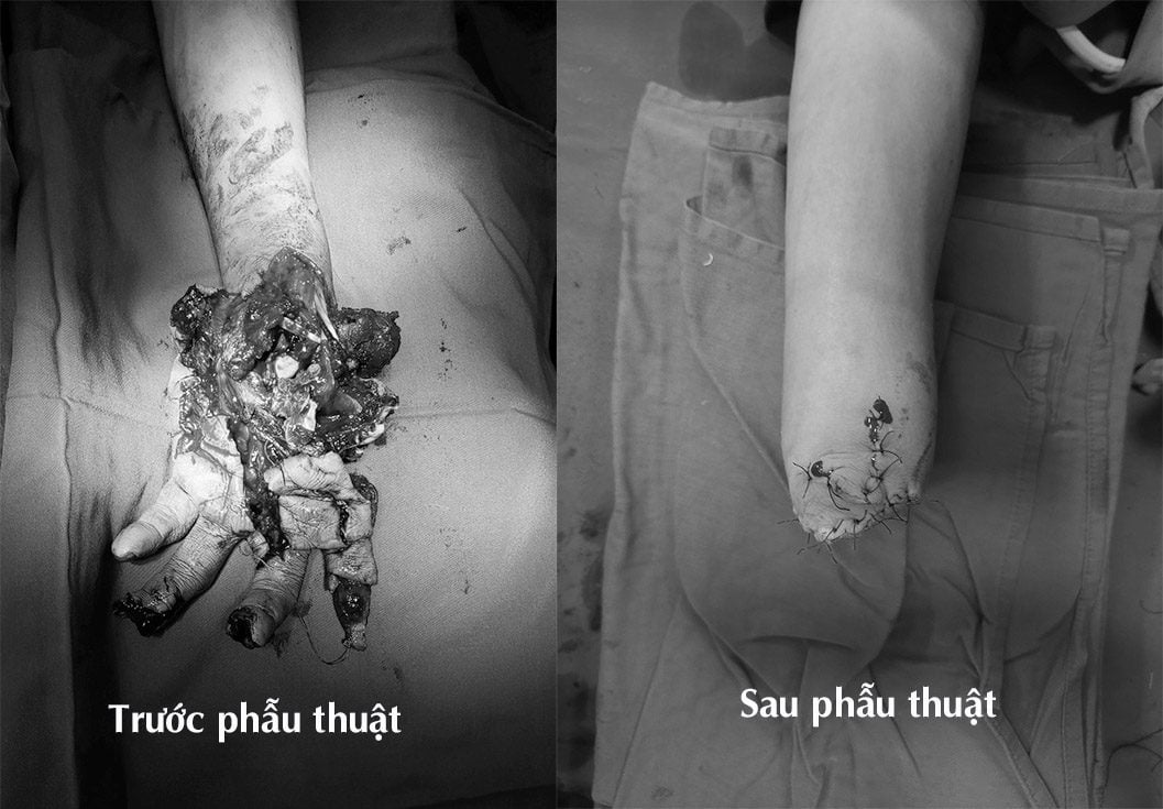 Hình ảnh tay người bệnh H bị pháo nổ trước và sau phẫu thuật 