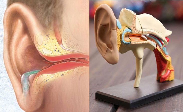 Viêm tai giữa gồm 3 thể là viêm tai giữa cấp tính, mạn tính và viêm tai giữa có dịch tiết