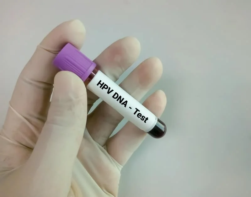 Tiến hành kiểm tra HPV trong máu bằng xét nghiệm test HPV
