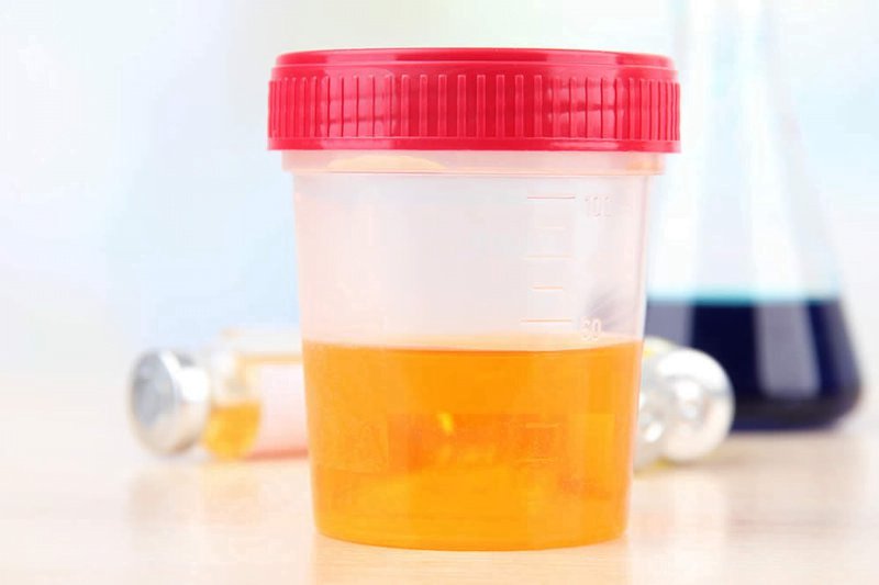 3 triệu chứng của bệnh viêm tuyến tiền liệt ở nam giới 1 Nước tiểu của những người bị viêm tuyến tiền liệt thường sẽ có màu vàng sậm