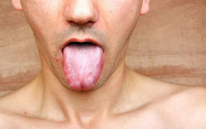 Giang mai ở lưỡi khi quan hệ tình dục bằng miệng 