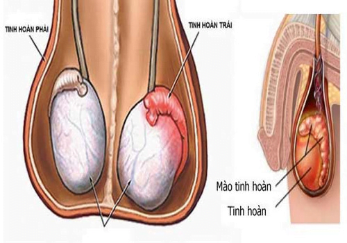 Nang mào tinh hoàn