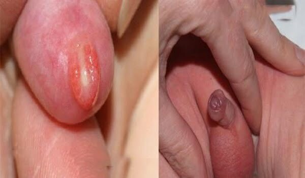 Viêm bao quy đầu ở trẻ em