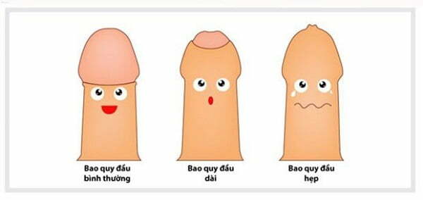 Viêm bao quy đầu ở trẻ em