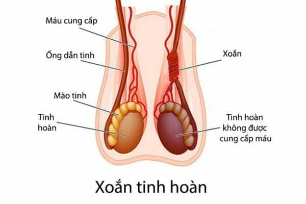 xoắn tinh hoàn