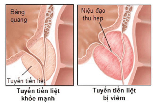 Bệnh lậu mủ ở nam giới có ảnh hưởng tới sinh sản không?
