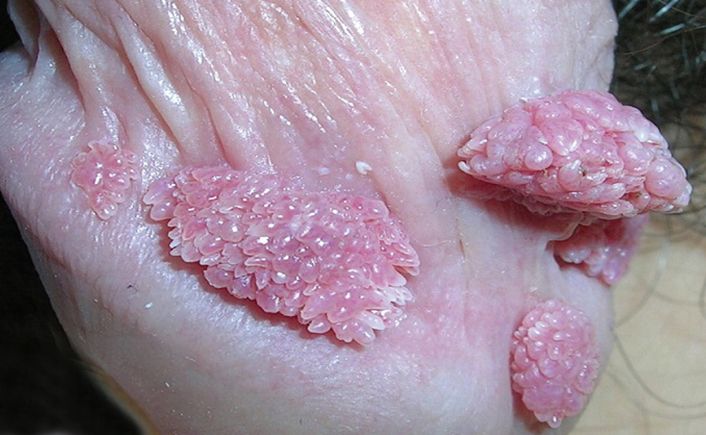 Top 9 Bệnh lây qua đường tình dục phổ biến hiện nay 6 Khí hư ra nhiều trong bệnh viêm âm đạo