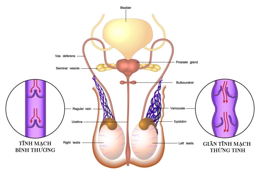 Triệu chứng và cách điều trị giãn tĩnh mạch thừng tinh dấu hiệu 