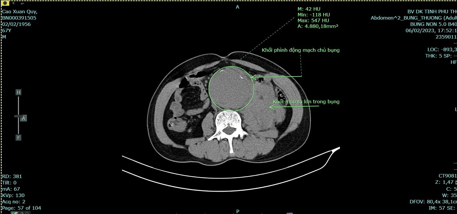 Hình ảnh chụp CT của người bệnh vỡ phình động mạch chủ bụng trước phẫu thuật