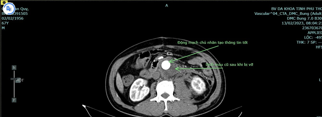 Hình ảnh chụp CT của người bệnh vỡ phình động mạch chủ bụng sau phẫu thuật