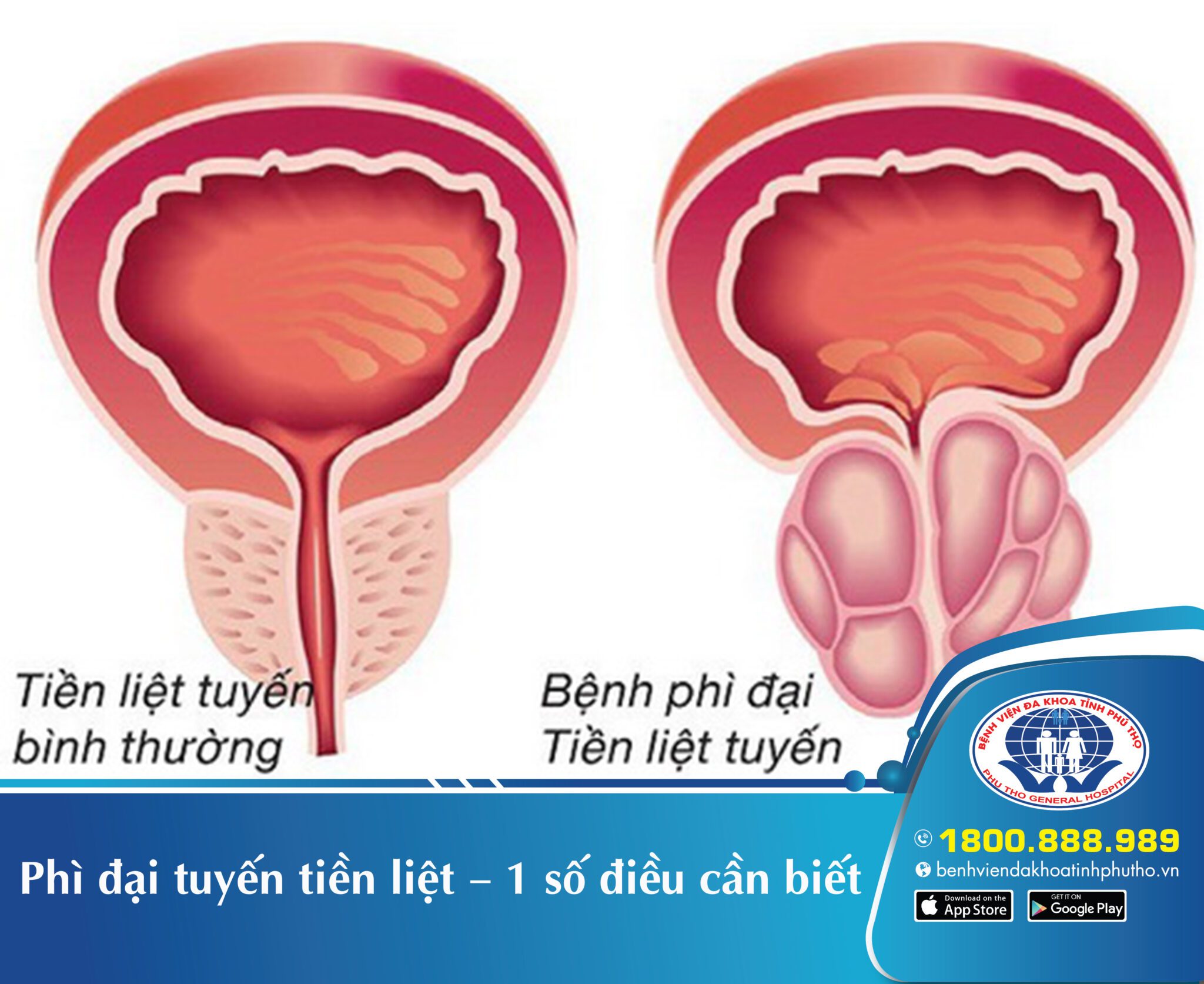 Phì đại tuyến tiền liệt – 1 số điều cần biết 1 Phì đại tuyến tiền liệt – 1 số điều cần biết