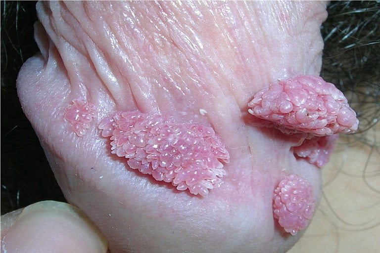 Hình ảnh sùi mào gà ở dương vật của nam giới 