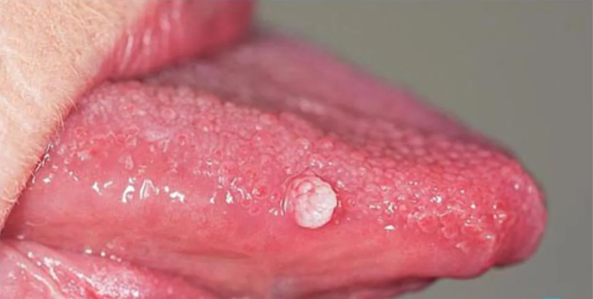 Hình ảnh sùi mào gà ở lưỡi trong trường hợp bệnh nhân hay Oralsex 