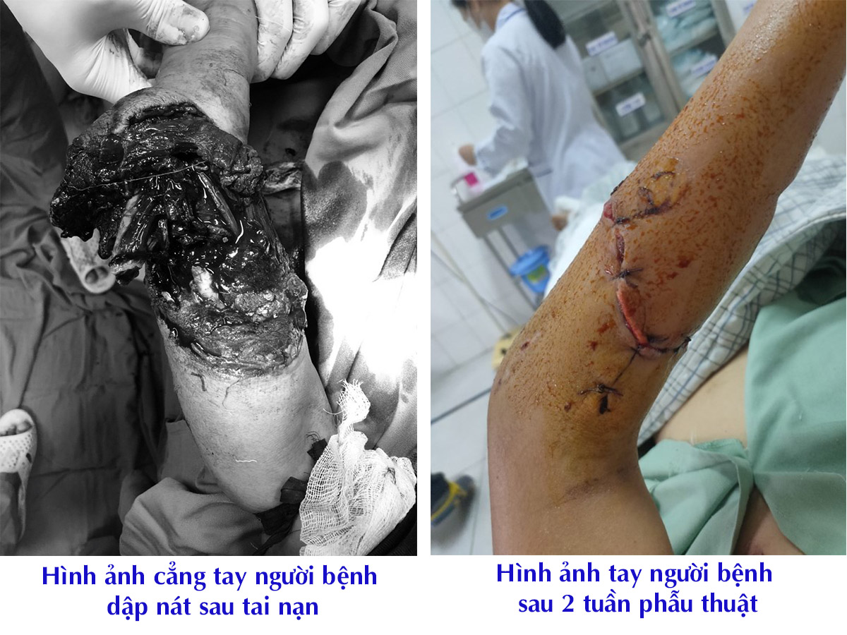 Hình ảnh cẳng tay dập nát của người bệnh sau tai nạn và sau 2 tuần phẫu thuật