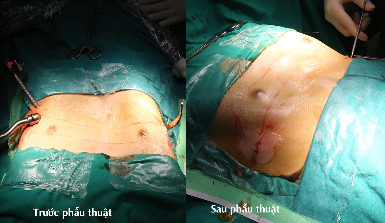 Hình ảnh người bệnh trước và sau phẫu thuật lõm ngực