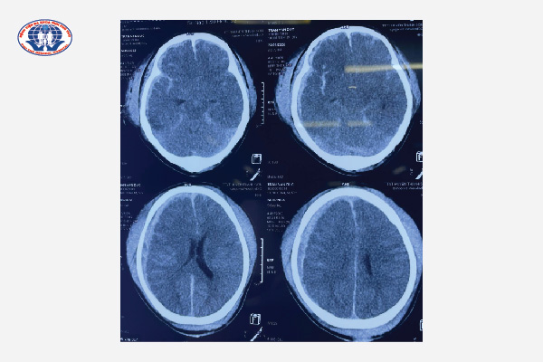 Hình ảnh phim chụp của người bệnh chảy máu não, phù não nặng.