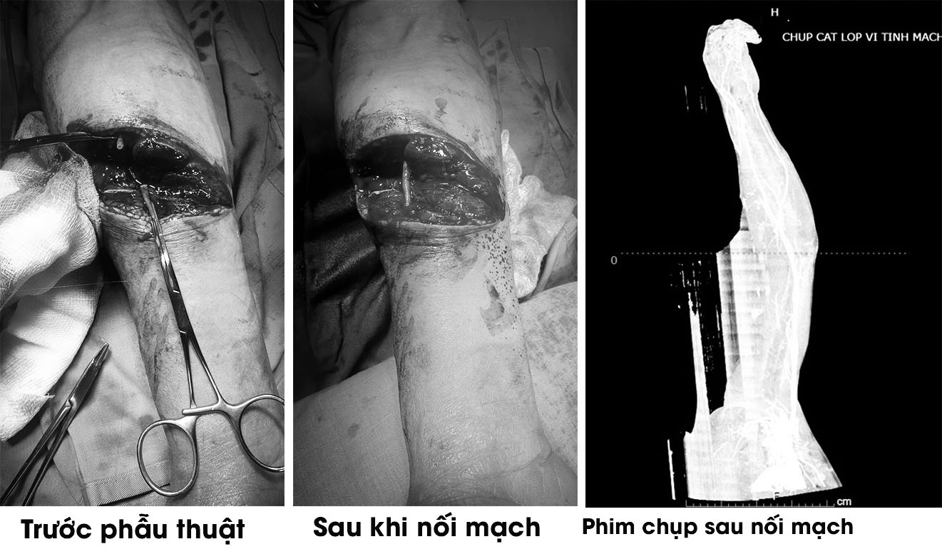 Hình ảnh tay của người bệnh đứt động mạch quay trước và sau phẫu thuật