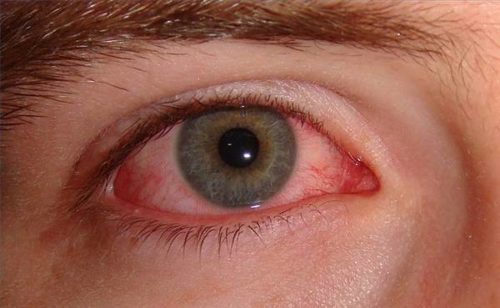 Viêm giác mạc gây đỏ, đau nhức và kích ứng mắtẢnh (Nguồn Internet) 
