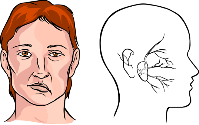 Khuôn mặt của người bệnh bị liệt dây thần kinh số 7