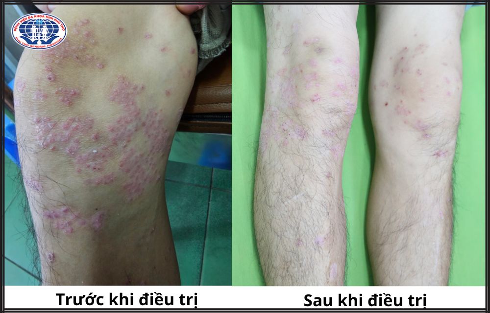 Khớp chân của người bệnh viêm khớp vảy nến trước và sau khi điều trị