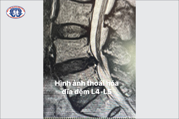 Hình ảnh phim chụp cộng hưởng từ của người bệnh bị thoái hóa đĩa đệm L4 – L5