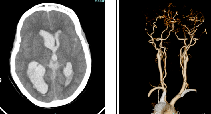 Hình ảnh Chụp CT Cắt lớp vi tính sọ não