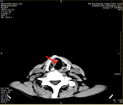 Hình ảnh chụp CT của người bệnh trước khi sử dụng thuốc Nam
