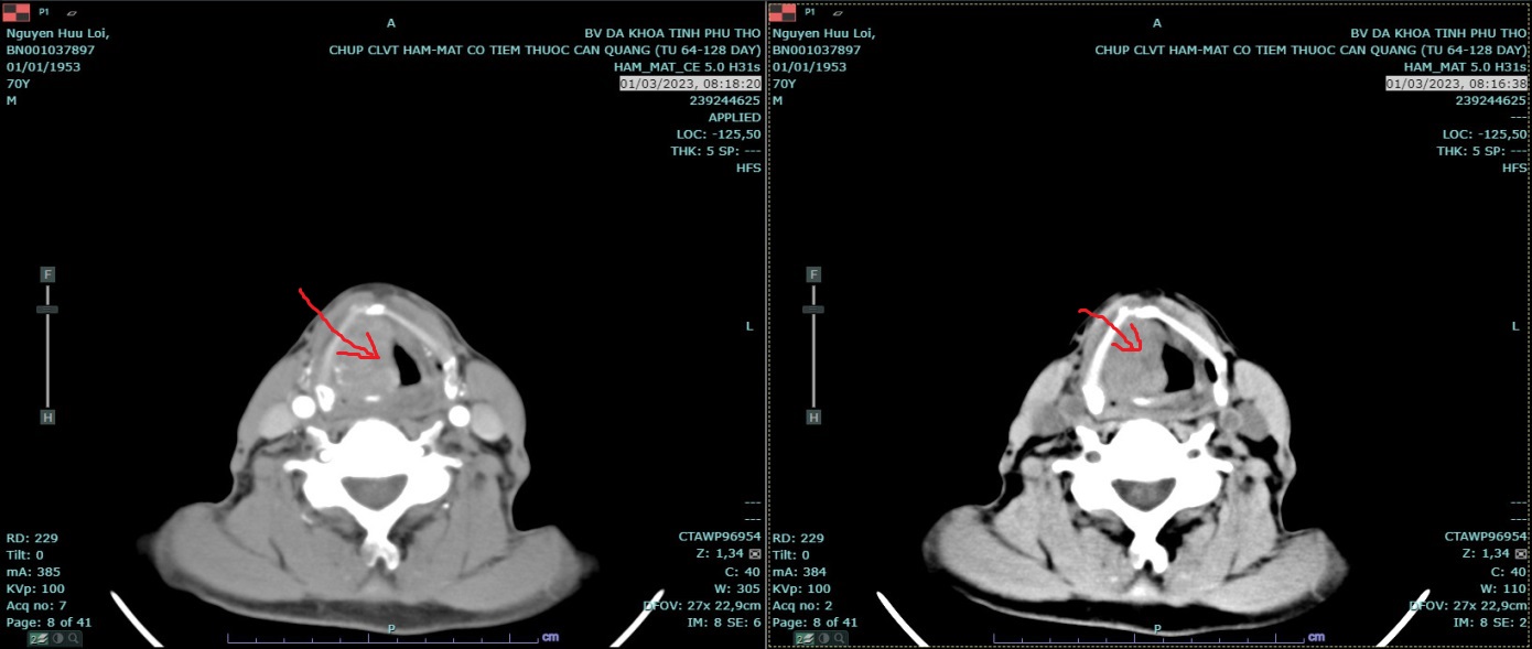 Hình ảnh chụp CT của người bệnh sau khi sử dụng thuốc Nam
