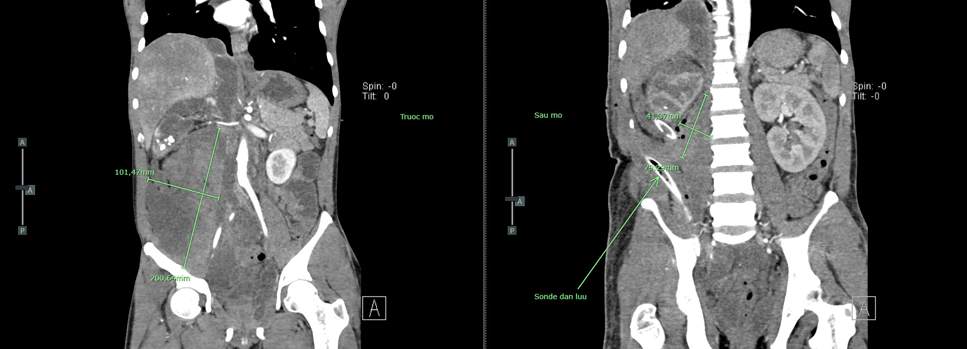 Hình ảnh chụp CT cắt lớp vi tính vùng áp xe: Trước và Sau phẫu thuật