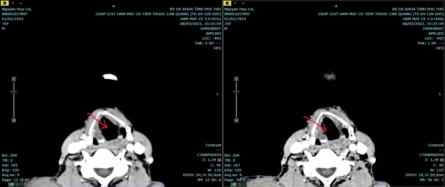Hình ảnh chụp CT của người bệnh sau khi điều trị tại Khoa Xạ Trị theo phác đồ của bác sĩ