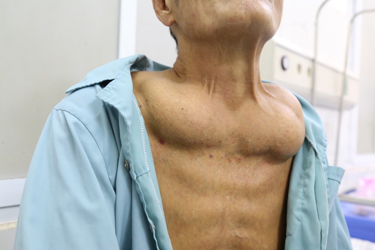 Hình ảnh khối u to chèn ép vùng cổ họng của người bệnh mắc Madelung tại BVĐK tỉnh Phú Thọ