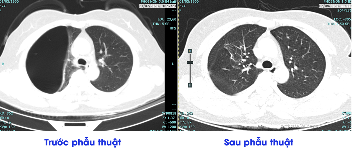 Hình ảnh chụp CT của người bệnh kén khí phổi trước và sau phẫu thuật