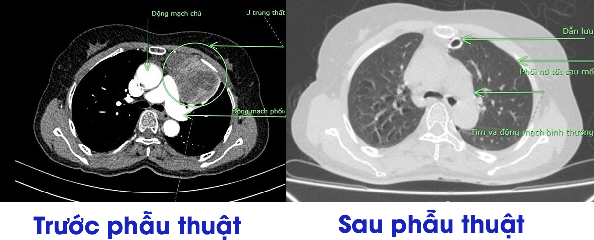 Hình ảnh chụp CT khối u trung thất của người bệnh trước và sau phẫu thuật