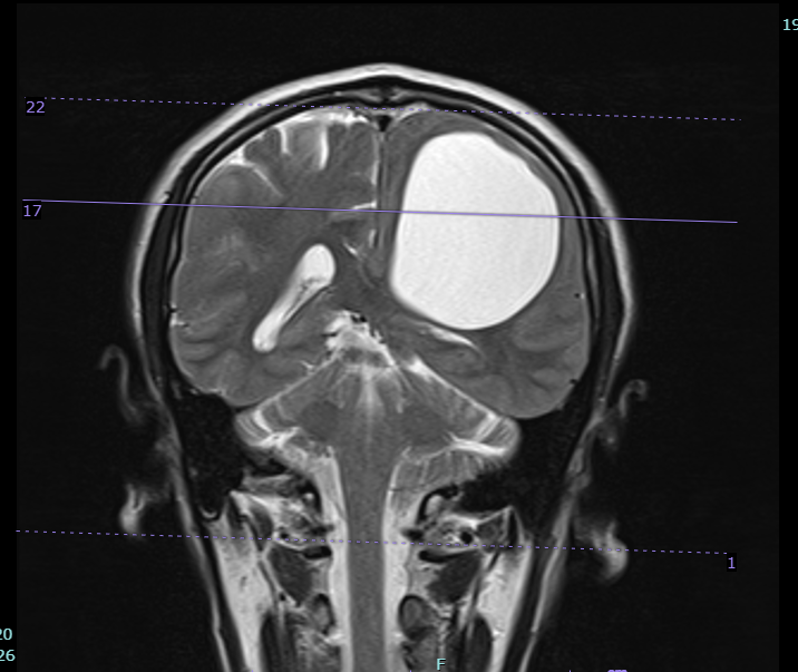 Ảnh MRI trước mổ của bệnh nhân liệt nửa người: Nang sán lớn nhất nằm trong nhu mô bán cầu não bên trái