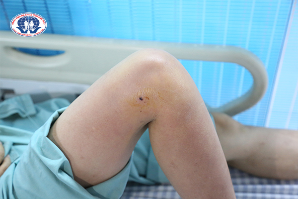 Hình ảnh vết mổ trên đùi phải của người bệnh bị gà trống tấn công