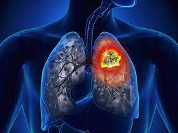 Dấu hiệu nhận biết sớm Ung thư phổi