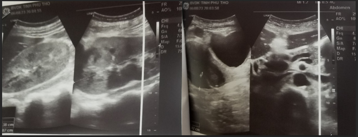 Hình ảnh siêu âm ruột thừa và thận của bệnh nhân trước và sau khi điều trị